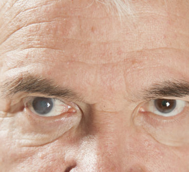 Cataracts Awareness: What You Need to Know